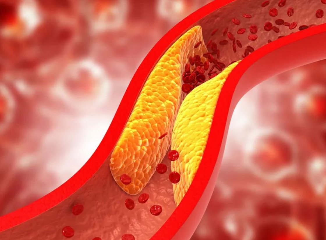 研究发现：HIV病毒中的Nef蛋白是导致感染者更容易出现粥样动脉硬化的关键因素