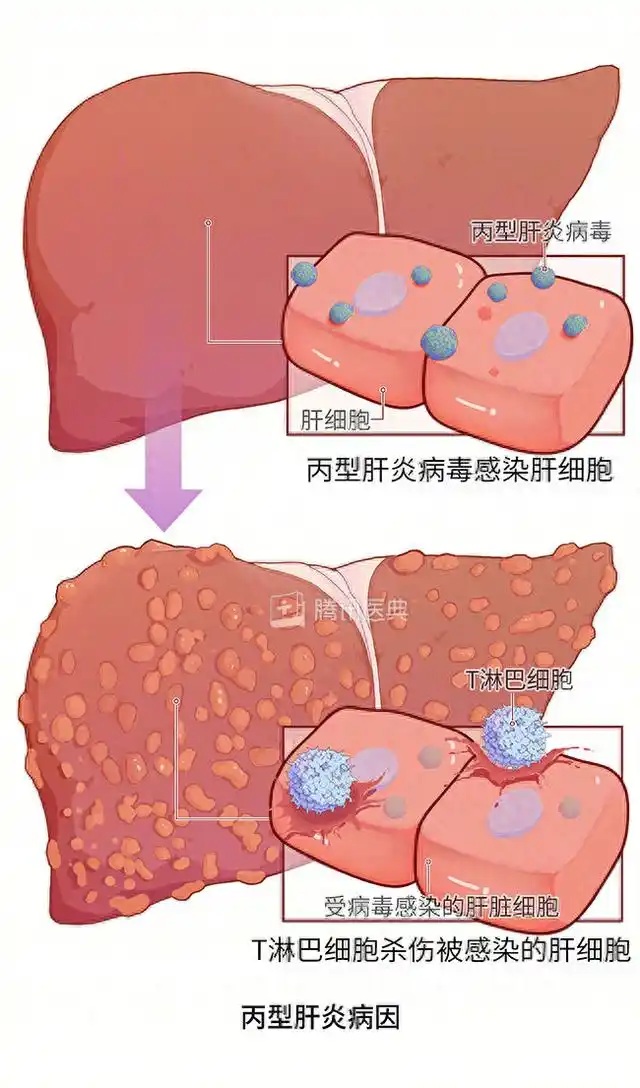 【双语】HIV感染者如果感染了乙肝？ ئەيدىزدىن يۇقۇملانغۇچىلار ب تىپلىق جىگەر ياللۇغى بىلەن يۇقۇملانسا