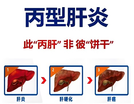 【双语】科普 | 别让丙肝悄悄“搞破坏” پەننى ئومۇملاشتۇرۇش | ب تىپلىق جىگەر ياللۇغىنى ئاستا «بۇزغۇنچىلىق قىلىش»غا يول
