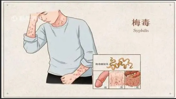 【双语】梅毒疹是几期梅毒会出现的症状？ سىفلىس ئەسۋىسى قانچە باسقۇچلۇق سىفلىسنىڭ ئالامىتى؟