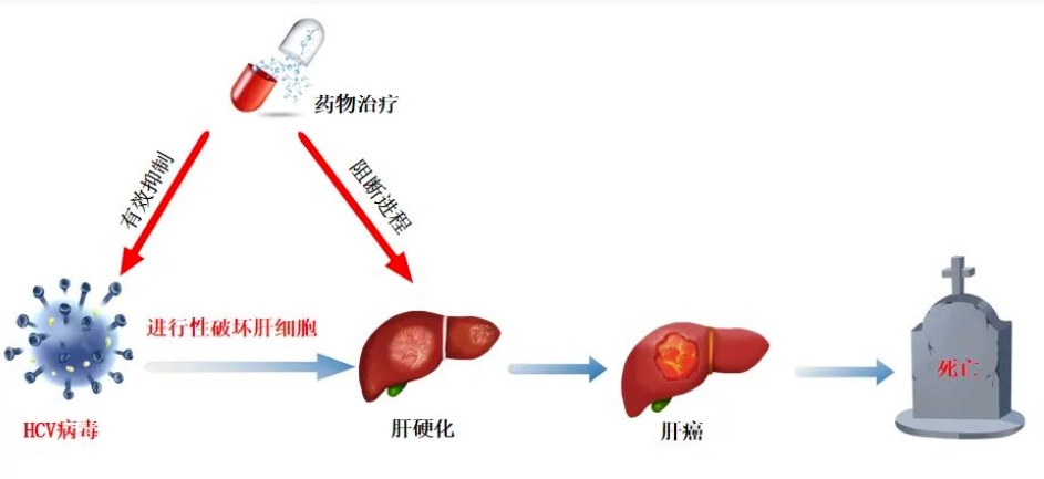 【双语】《丙肝不是绝症：可治愈、能报销，一篇读懂！》 س تىپلىق جىگەر ياللۇغى ساقايماس كېسەل ئەمەس: داۋالىغىلى، ئاتچوت قىلغىلى ب