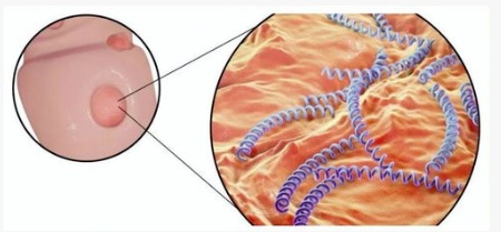 【双语】《小心！这个病会“模仿”十几种皮肤病，很多人中招了还不知道》 «ئېھتىيات قىلىڭ بۇ كېسەل ئون نەچچە خىل تېرە كېسىلىنى دورىيالايدۇ،