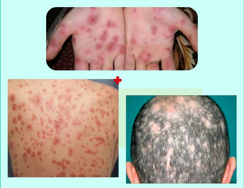 【双语】【健康警报】梅毒治疗的黄金窗口：在“全面爆发”与“终身伤害”之间  ساغلاملىق ئاگاھلاندۇرۇشى: سىفلىسنى داۋالاشنىڭ ئالتۇن كۆزنىكى: