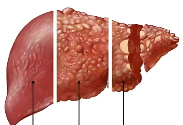 【双语】用“肝”着急，丙肝可防可治愈 قۇرۇق ئالدىرماڭ ، س تىپلىق جىگەر ياللۇغى ۋىرۇسىنىڭ ئالدىنى ئالغىلى بولىدۇ