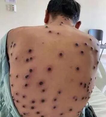 广西：疾控通报HIV感染者停药后性行为感染猴痘死亡病例