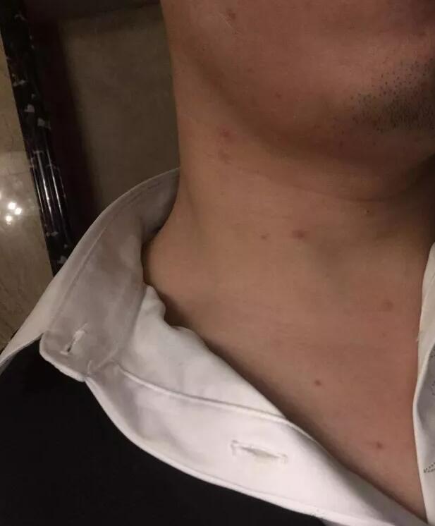 长期无T，如果身体出现这个东西，是感染HIV的信号！