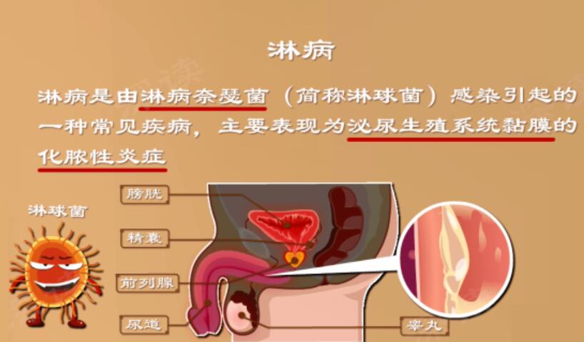 可致不育的淋病，男生必看！