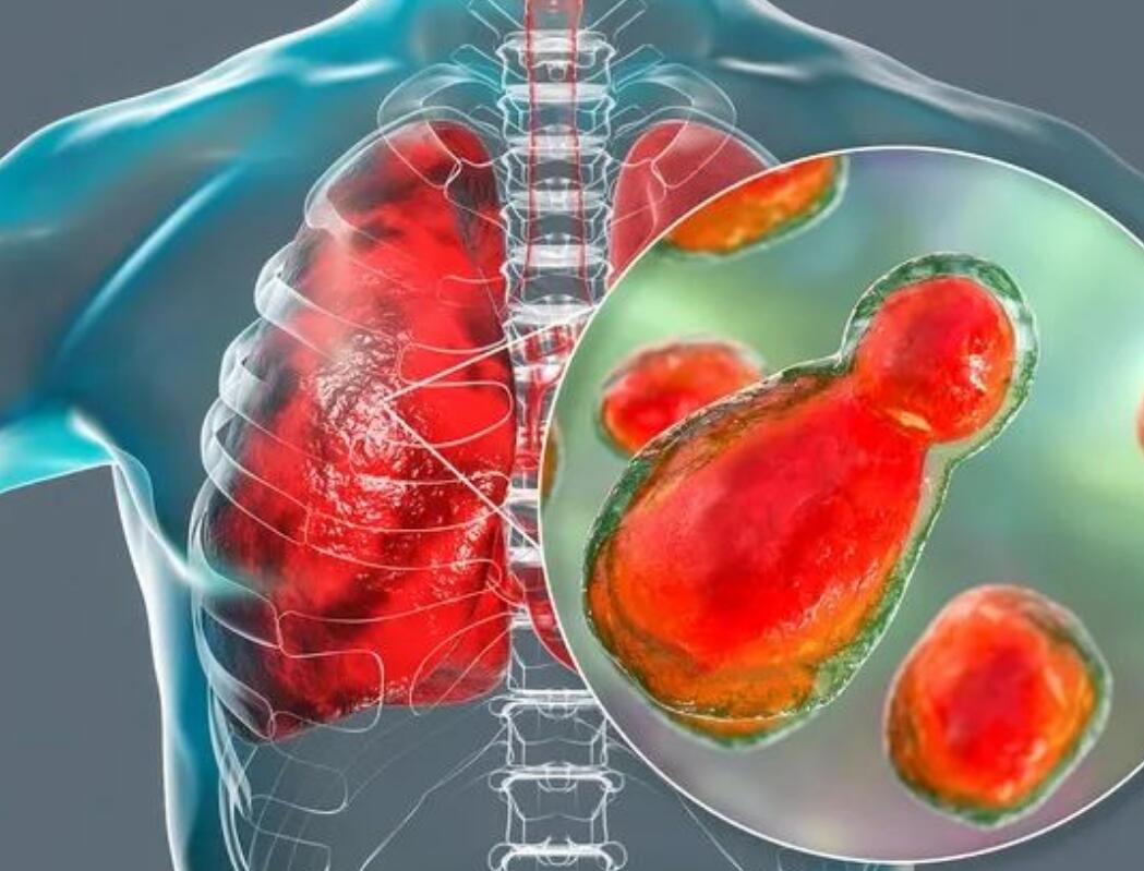 最常见的HIV机会性感染（有图慎入）