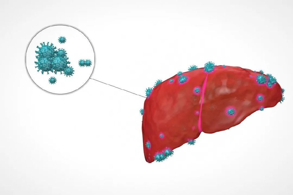 【双语】HIV感染者如果感染了乙肝？ ئەيدىز دىن يۇقۇملانغۇچىلار بتىپلىق جىگەر ياللۇغى بىلەن يۇقۇملانسا