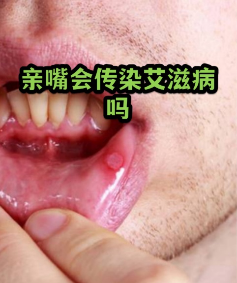【双语】接吻会传染艾滋病吗？揭秘艾滋病的真实传播途径  سۆيۈشۈش ئارقىلىق ئەيدىز كېسىلى يۇقامدۇ؟ ئەيدىز كېسىلىنىڭ ھەقىقىي تارقىلى