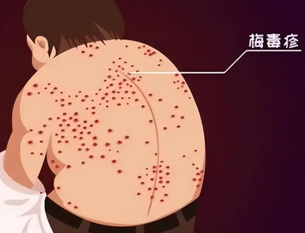 梅毒卷土重来？一个被忽视的母婴传播疾病