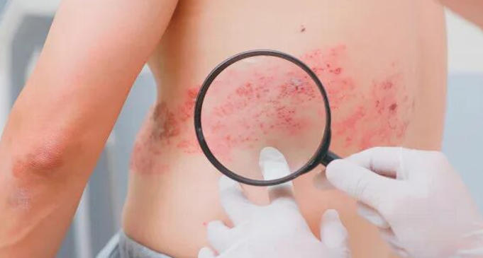HIV感染者的带状疱疹风险高出常人两倍：疫苗接种是预防的首选吗？